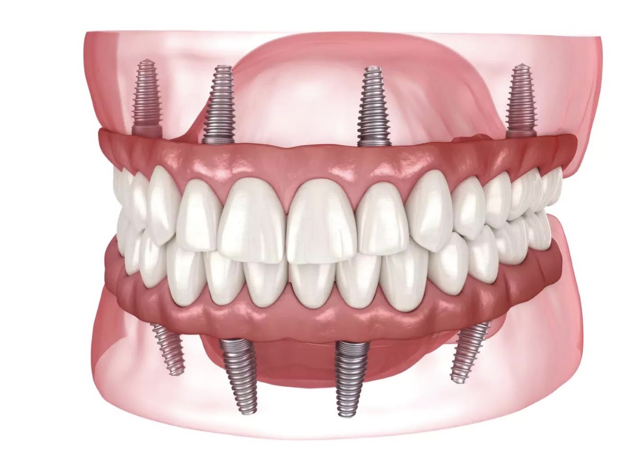 Dental Implants (All-on-4)