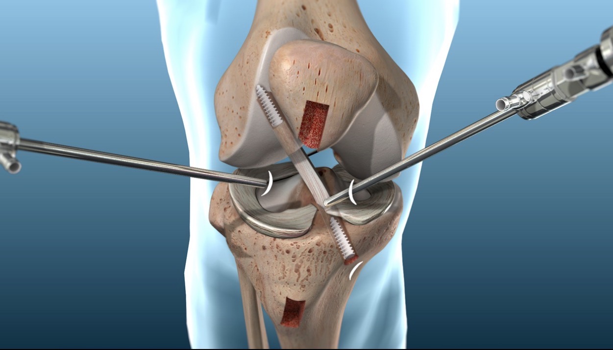 Sports Injury Treatment