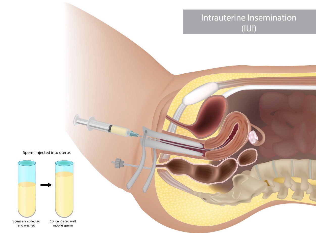IUI (Intrauterine Insemination)