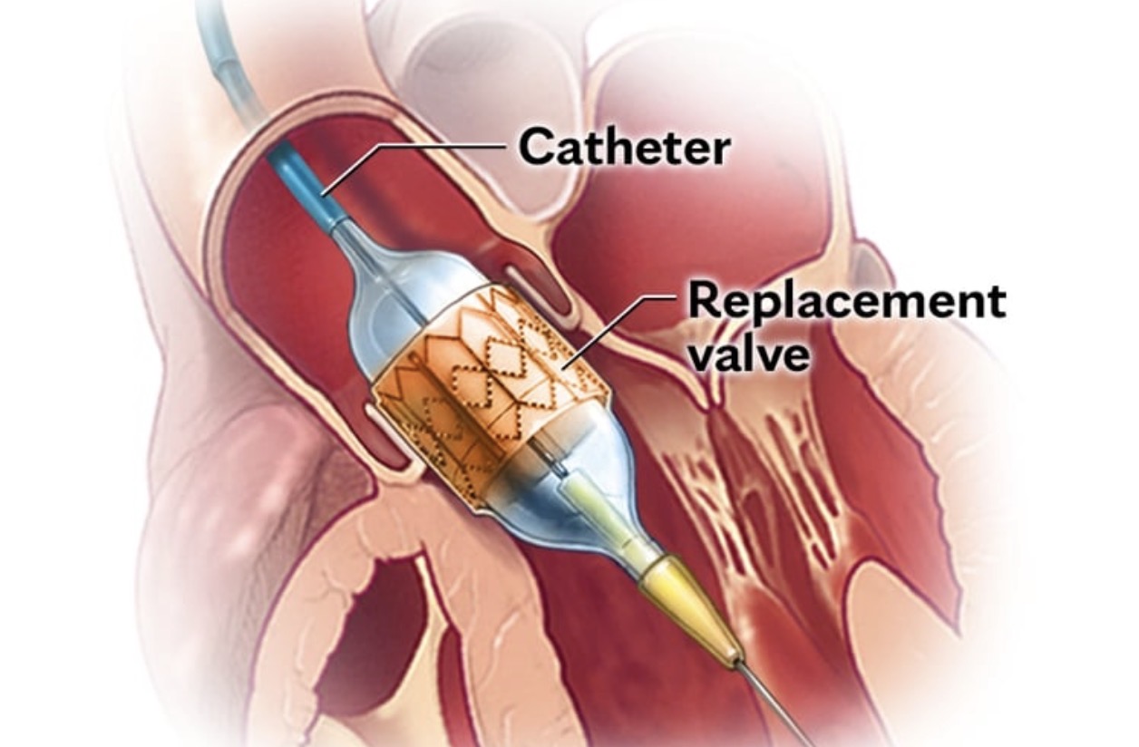 TAVI / TAVR (Transcatheter Aortic Valve Implantation)