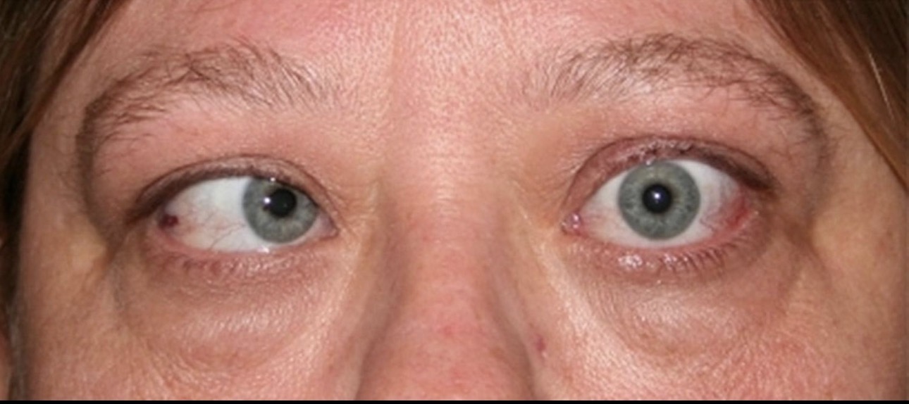 Strabismus (Eye Misalignment)