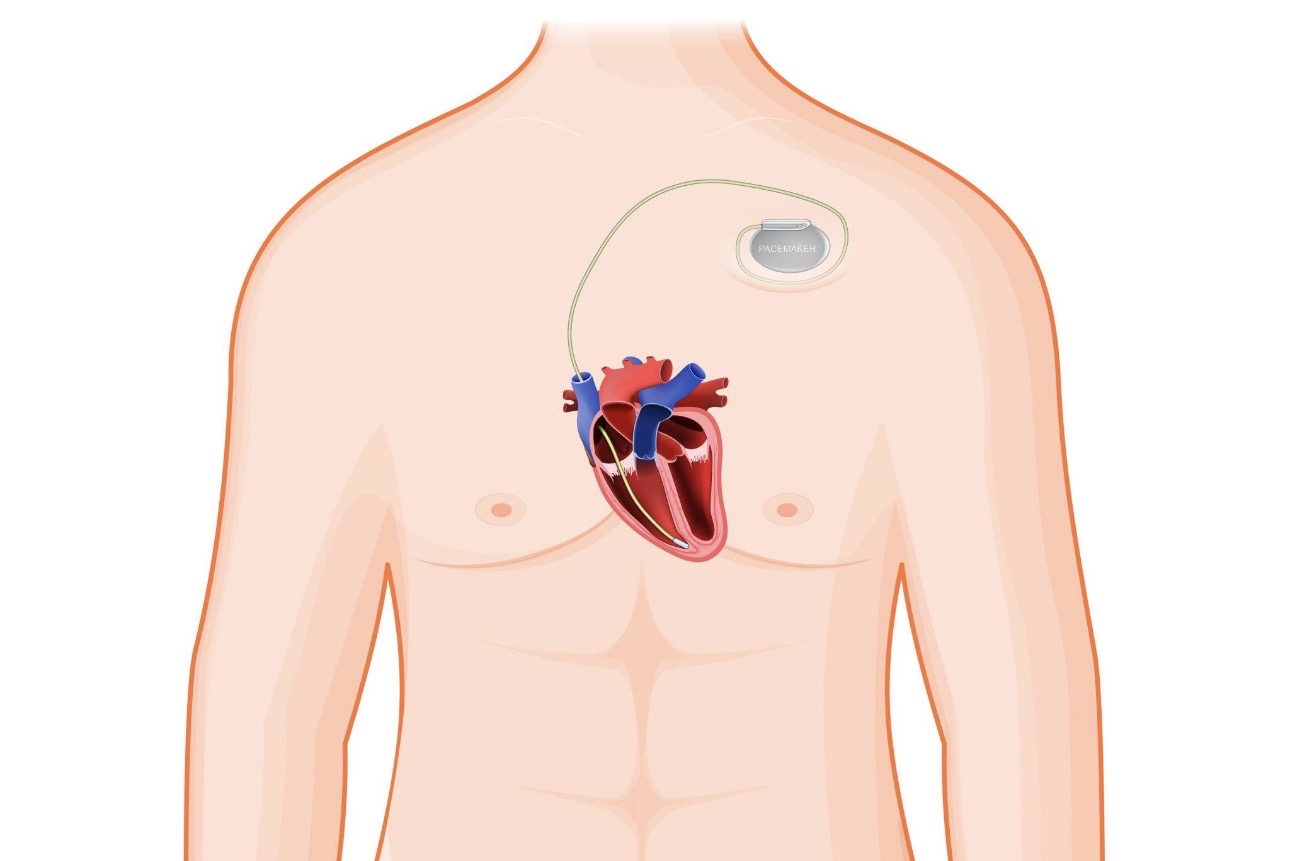Pacemaker Implantation